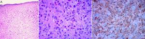 Biopsia de piel: A y B) Infiltrado dérmico de histiocitos y eosinófilos (H/E 40x y 100x, respectivamente). C) Inmunohistoquímica: marcador CD68 positivo.