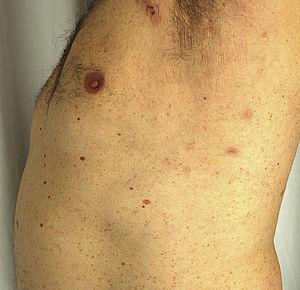Máculas residuales en axila izquierda correspondientes a lesiones de dermatosis pustulosa subcórnea a las tres semanas del inicio del tratamiento con adalimumab.