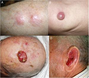 A) Ejemplo de presentación clínica de 4 pacientes con carcinoma de células de Merkel en forma de lesiones nodulares subcutáneas; B) tumoración eritematosa aislada; C y D) dos lesiones ulceradas o de superficie friable.