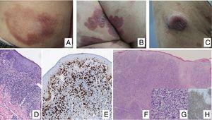 (A) Lesión de micosis fungoide (MF) en fase macular. (B) Lesión de MF tipo placa. (C) MF tumoral. (D) Histología de MF en placa con infiltrado en banda de dermis reticular superficial y media con linfocitos atípicos de gran tamaño. Asocia fenómenos de epidermotropismo. (E) El indicador de proliferación Ki67 permite detectar las células linfoides de gran tamaño. (F) Infiltrado difuso en toda la dermis correspondiente a una lesión de MF tumoral. (G) Células de gran tamaño y núcleo pleomórfico de una biopsia de MF tumoral. (H) Índice de proliferación >50% en una lesión de MF tumoral.
