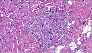 Invasión perineural (neurotropismo) por células de melanoma. Hematoxilina y eosina, ×200.