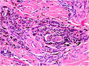 Invasión intraneural (neurotropismo) por células de melanoma. Hematoxilina y eosina, ×200.