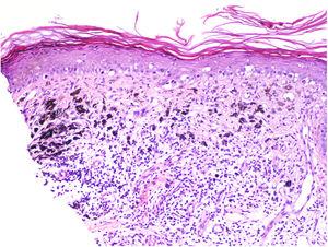 Reemplazo de las células tumorales por inflamación linfocitaria, atenuación de la epidermis y melanofagia y numerosos vasos telangiectásicos en área de regresión de melanoma. Hematoxilina y eosina, ×100.