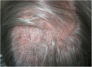 Placa de alopecia con descamación difusa y eritema de base.