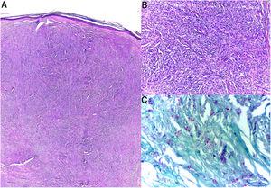 Histopatología. A,B (H&E): Dermis con acúmulos nodulares de células histioides, morfología fusiforme en patrón estoriforme. C: Coloración Fite-Faraco. Múltiples bacilos ácido-alcohol resistentes.