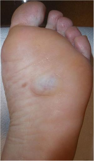 Imagen clínica donde se aprecia una lesión nodular, azulada, de aproximadamente 3cm de tamaño.