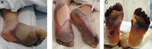Exacerbación progresiva en un paciente con COVID-19 y fenómenos isquémicos acrales, desarrollando ampollas y finalmente gangrena seca en los pies. Fuente: Zhang et al.29.