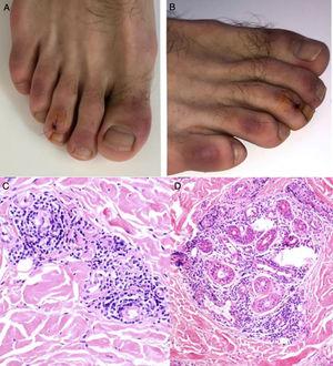 A y B) Placas violáceas infiltradas con fondo eritematoso en las regiones dorsal de los dedos y lateral de los pies. C y D) Biopsia de lesión en el tercer dedo del pie derecho, HE. C) Se observa infiltrado linfocítico con ocasionales células plasmáticas en estrecho contacto con los vasos, sin evidencia de fibrina o trombos. HE 40×. D) Se observa un infiltrado periecrino. HE 40×. Fuente: Kolivras et al.33.