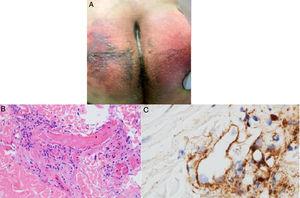 A) Paciente masculino de 32años con púrpura retiforme en glúteos 4 días posteriores al inicio de soporte ventilatorio mecánico por falla respiratoria aguda asociada a SARS-CoV-2. B) Biopsia de piel con una gran trombosis vascular pauciinflamatoria con daño de células endoteliales. HE 40×. C) Depósitos de C5b-9 dentro de la microvasculatura. Diaminobencidina 40×. Fuente: Magro et al.38.