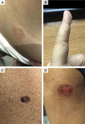 Imágenes enviadas a través de la App. A) Pitiriasis rosada. B) Escabiosis. C) Lesión pigmentada que precisa estudio dermatoscópico. D) Impétigo.