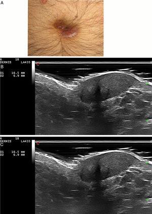 Granuloma facial. A) Caso 3: nódulo violáceo en el ombligo. B) Lesión hipoecoica, bien definida y heterogénea en dermis e hipodermis, de 6,9mm de espesor (sonda de 18MHz, modo B). C) Aumento marcado de la vascularización (sonda de 18MHz, modo Doppler color).