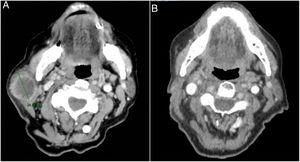 Imagen de tomografía axial computarizada de tumoración mandibular derecha antes (A) y tras 4 ciclos de pembrolizumab (B).