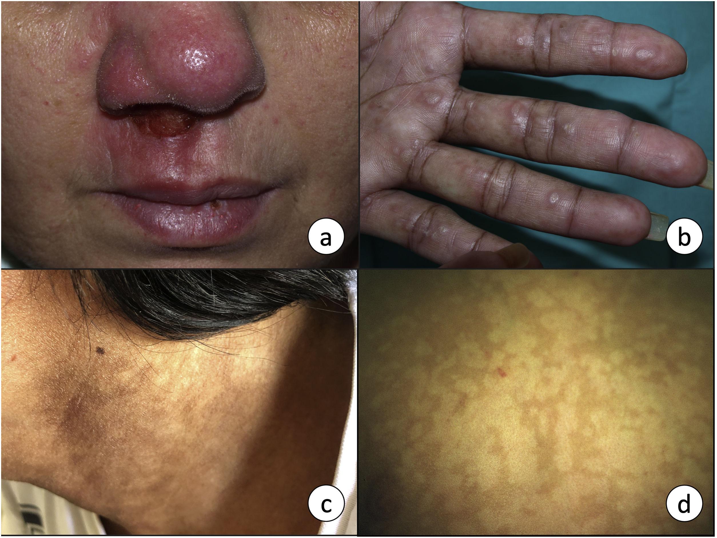 Fluconazole Más Barato