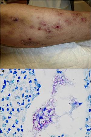 Ejemplo de infección por M.chelonae. A)Lesiones nodulares, dolorosas y supurativas, con ulceración superficial y formación de costra (Cortesía de la Dra. Rodríguez Blanco). B)Infección por M.chelonae. En ocasiones, los microorganismos tienden a agruparse en las áreas de supuración, donde pueden demostrarse con la tinción de Ziehl-Neelsen (Ziehl-Neelsen, ×1.000).