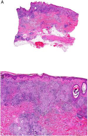 Enfermedad de Crohn. Dermatitis granulomatosa con múltiples granulomas en la dermis reticular, respetando la epidermis y la dermis papilar (A: H&E ×20). Los granulomas son similares a los que se observan en el tracto digestivo: no caseificantes, con células gigantes multinucleadas, y pueden tener un denso infiltrado linfocitario (B: H&E ×40).