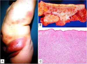 Piel laxa granulomatosa. A) Varón de 11 años con masas cutáneas infiltradas («piel redundante») y eritematosas en cintura pélvica. B) Pieza quirúrgica con engrosamiento dermo-hipodérmico. C) Infiltración linfoide difusa de la dermis (H&E ×40).