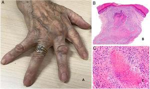 A) Artritis reumatoide. Aspecto clínico de 2 nódulos reumatoides en proximidad a las articulaciones interfalángicas de la mano. Tienen una superficie lisa y blanquecina, sin signos inflamatorios. B) Artritis reumatoide. Panorámica histológica de un nódulo reumatoide. En este caso la lesión alcanza zonas superficiales de la dermis y se extiende a tejidos profundos. Se reconoce una estructura de granuloma en empalizada con centro necrótico intensamente eosinófilo (H&E ×20). C) Artritis reumatoide. Detalle histológico del granuloma en empalizada que constituye la base histológica del nódulo reumatoide. Alrededor de un centro de necrosis fibrinoide de coloración intensamente eosinófila se dispone una capa de histiocitos en empalizada (H&E ×200).