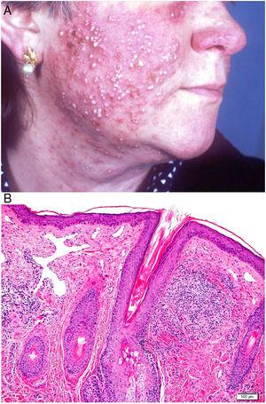Rosácea. A) Pápulas, pústulas y nódulos quísticos en la cara. B) Rosácea. Granuloma parafolicular con telangiectasias dérmicas superficiales (H&E ×100).