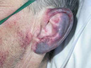Lesión purpúrica en pabellón auricular.