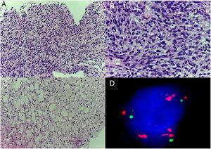 Histología y FISH: la anatomía patológica con hematoxilina-eosina muestra una proliferación neoplásica de células fusiformes (A y B) y áreas focales compatibles con diferenciación grasa (C). El estudio con FISH muestra una amplificación de MDM2 en el brazo largo del cromosoma 12 (D).