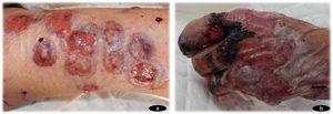a) Lesiones eritemato-ampollosas ulceradas de forma targetoide. b) Afectación del dorso de la mano con desepitelización por desprendimiento de ampolla de gran tamaño.