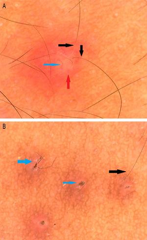 A) Lesión foliculocéntrica con eritema circundante (flecha roja), vaso tortuoso (flecha azul) e hipopigmentación del tallo piloso proximal (flecha negra). B) Rotura del pelo (flecha azul) e hipopigmentación del tallo piloso proximal (Dino-Lite AM4115ZT; ×150; Polarizer).