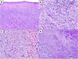 A) MD con elastosis actínica y atrapamiento de material elastótico (HEx100). B) MD con un agregado nodular de linfocitos (HEx200). C) MD con invasión perineural. (HEx200). D) MD combinado. En el extremo superior derecho se identifica el componente de melanoma no desmoplásico formado por nidos compactos de melanocitos epitelioides. En la región inferior, se observa el componente desmoplásico que representa menos del 90% del tumor infiltrante (HEx100).