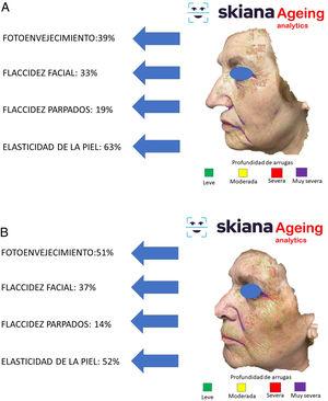 Aplicación para smartphone SkianaCare®: clasificador de acné. A. Ejemplo en varón con acné leve. B. Ejemplo en mujer con acné moderado.