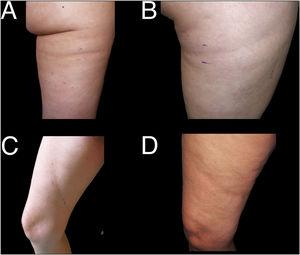 Examples of cases of lipoatrophia in bands on the lower limbs (Group II). A and B, lipoatrophia in bands on the posterior surface of the thighs; atypical location of LS (Group iia). C and D, oblique lesions on the inside surface of the thigh; atypical location of LS (Group iib).