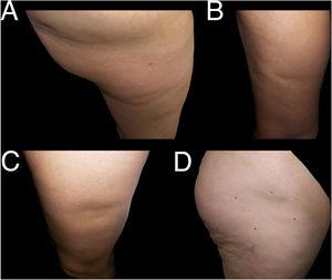 Examples of cases of nonspecific lipoatrophia (Group III). A and B, lipoatrophia in other locations (Group iiia): on the buttock (A) and on the posterior surface of the arm (B). C and D, lipoatrophia with other morphologies (Group iiib): lipoatrophia with an almost oval form on the outside surface of the left thigh (C) and lipoatrophia with a round-oval form in the anterolateral region of the proximal third of the right thigh (D).