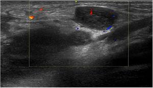 Ultrasound of the groin showing a hypoechogenic nodular image compatible with enlarged lymph nodes.