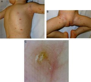 Nodular scabies. Multiple erythematous papules and nodules on the trunk and arms (A) and the lower extremities (B). C, Dermoscopy of a mite furrow on the right foot revealing the delta wing sign.
