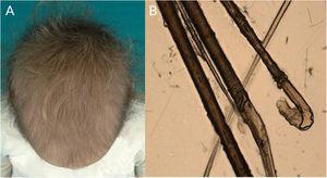 A) Hipotricosis en una niña con cabello anágeno suelto. B) Raíces anagénicas torsionadas y «ruffling» de la vaina interna del folículo piloso.