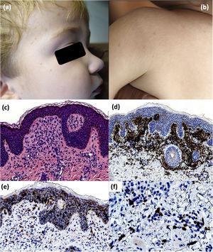 Segundo paciente. Clínica: Lesiones maculo-papulosas eritemato-marronáceas en zona facial, parte alta de la espalda y brazos (a y b). Histología: Infiltrado mononuclear dérmico superficial (c). La población dérmica es mayoritariamente positiva para CD163 (d). No se observa un número inusualmente alto de células positivas para CD1a (e). Se observa un ligero aumento de mastocitos perivasculares (f). (d, HE, ×200; e, CD163, ×100; f, CD1a, ×100; g, c-kit, ×400).