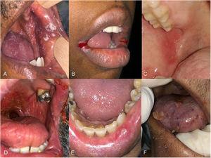 Lesiones orales en pacientes COVID-19. A) Candidiasis seudomembranosa. B) Queilitis angular. C) Enantema en carrillo. D) Úlceras en paladar blando y xerostomía. E) Úlcera labial «aftoide». F) Úlceras hemorrágicas en lengua.