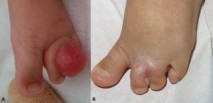 Caso 2. A) Nódulo rosado indurado entre segundo y tercer dedo de pie izquierdo. B) Recidiva meses después de exéresis completa y amputación digital.