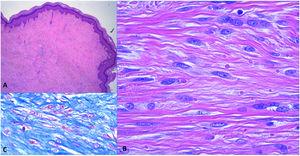 Histological findings. A, Proliferation of spindle cells occupying the entire thickness of the dermis (hematoxylin–eosin, original magnification ×4). B, Higher-magnification image of spindle cells (hematoxylin–eosin, original magnification ×40). C, Intracellular inclusions visualized using Masson trichrome stain (original magnification ×40).