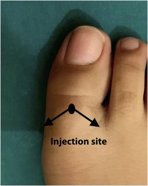 Performing the V technique. A single injection is required, directing the needle towards the plantar region in front of the metatarsophalangeal joint on both sides of the toe.