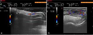 (a) High-frequency ultrasound showing a normal nail in the longitudinal plane. (b) Similar image of the distal phalanx. Note the thickened nail bed and increased vascularization.
