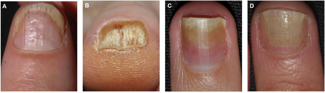 Nail Psoriasis: Diagnosis, Assessment, Treatment Options, and Unmet  Clinical Needs | The Journal of Rheumatology