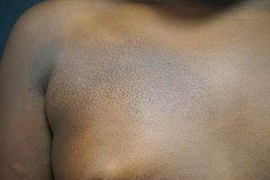 Clinical image of the 8-year-old patient. Multiple hyperpigmented papules with a follicular distribution.