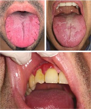 Fissured tongue (top left), geographic tongue (top right), and periodontitis (bottom) in patients with psoriasis.