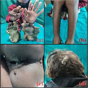 (a) Hyperkeratotic growths over the soles and palms and flexion deformity of the right hand. (b) Generalized follicular keratosis of the legs. (c) Hyperkeratosis in the gluteal cleft. (d) Pityriasis amiantacea of scalp.