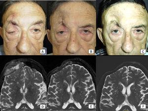 Case 8: advanced cSCC with orbital invasion, clinical perineural invasion, and regional nodal metastases. (A–C): clinical pictures of the patient before the start of therapy, after 2 cycles, and after 8 cycles, respectively. In (A), there is obvious ptosis of the right eyelid because of tumoral perineural invasion. (D–F): T2-weighted MRI images before the start of therapy, after 4 cycles, and after 18 cycles, respectively. The large, frontal mass seen in (D) has disappeared completely in (F), thus showing a complete treatment response.