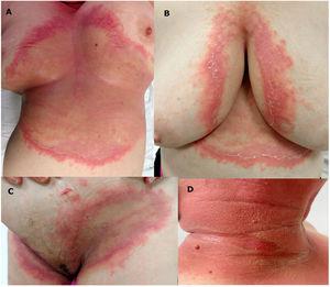 Erosive plaques with pustules in the submammary and intermammary regions, groin, neck, and antecubital fossa.