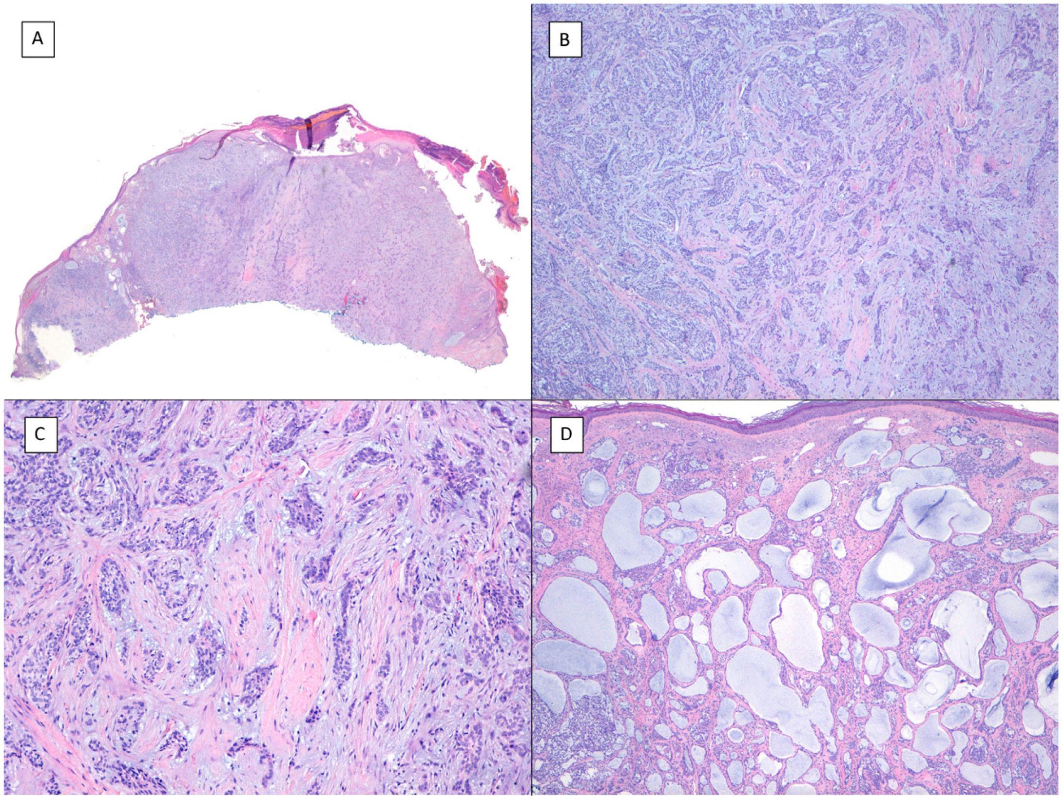 basal cell carcinoma vs squamous cell carcinoma histology