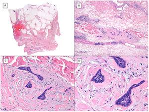 Subgaleal invasion (hematoxylin and eosin). A, BCC apparent only in the deepest part of the image; the entire dermis and hypodermis in most of the sections of this same tumor are disease-free (×10). B, The basaloid nests invade the subgaleal plane with no connection to the underlying planes (×100). C, Each of the epithelial nests is surrounded by dense and thickened collagen (×200). D, Detail of the tumor nests (×400).