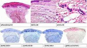 Anatomía patológica: epidermis con hiperqueratosis e hiperplasia irregular y proliferación de vasos en banda en dermis superficial. IHQ CD 31+,SMA+, D2-40 -.
