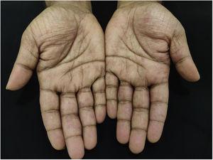 Clinical image of both palms showing erythematous patches.