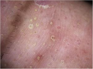 Dermoscopic image showing oval depressions and pits filled with yellowish plugs, peripheral scaling, linear vessels in a background erythema.
